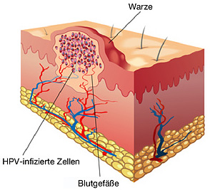 Warze in der Haut